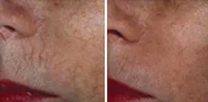 laser hair removal akron ohio
