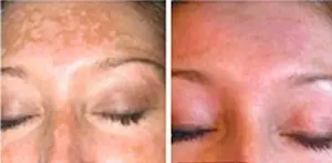 laser hair removal akron ohio
