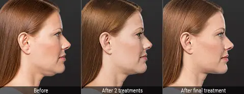 before after double chin kybella treatments