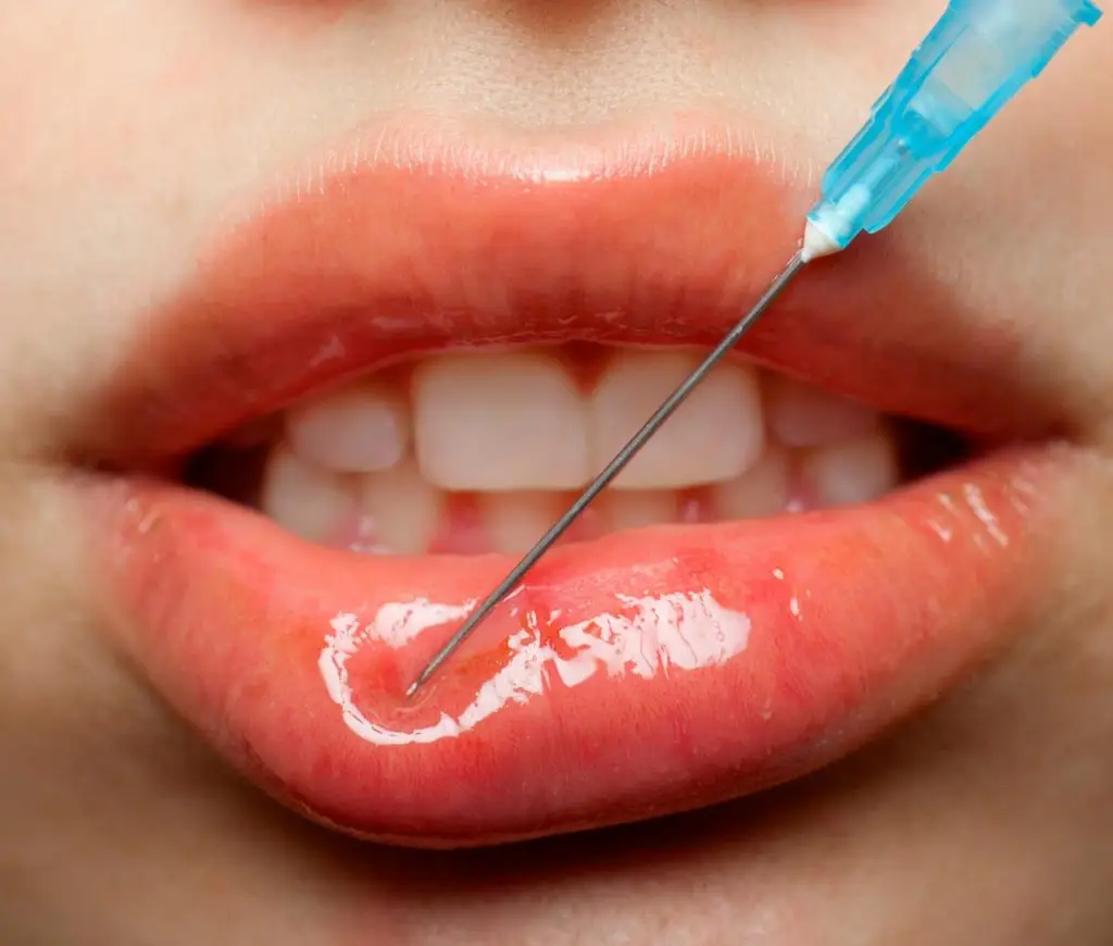 botox injection lips