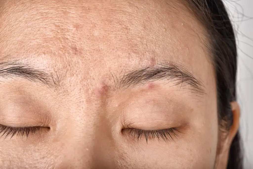 wrinkles, acnes, large pores, dark spots