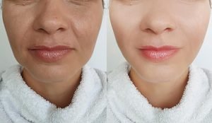 face wrinkles jowels before after