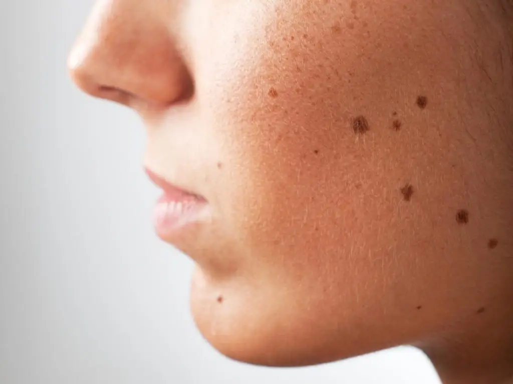 woman with sunspots moles and freckles on face