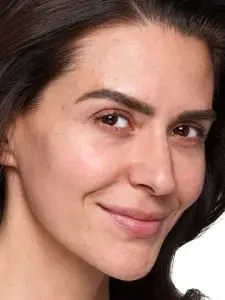 before skinvive treatment