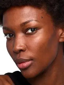 before skinvive treatment