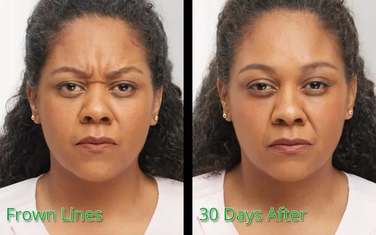Frown lines treatment before and 30 days after