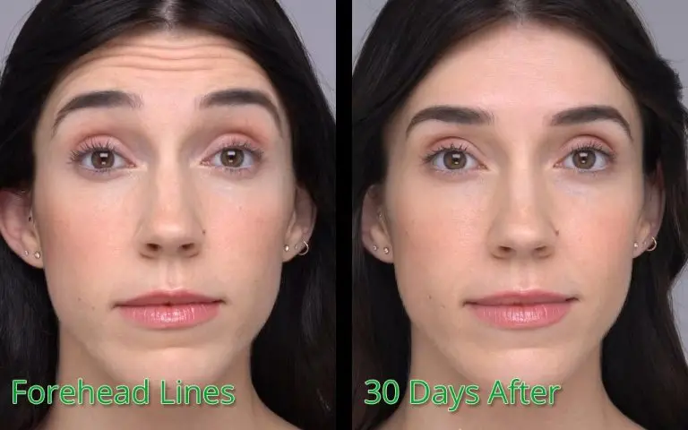 Forehead lines treatment before and 30 days after