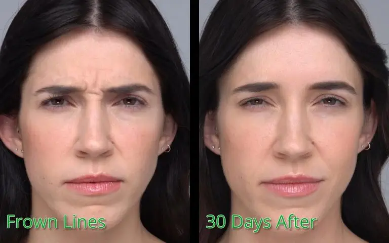 Frown Lines treatment before and 30 days after