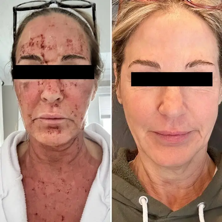 wrinkles, scars, and uneven skin tone improved