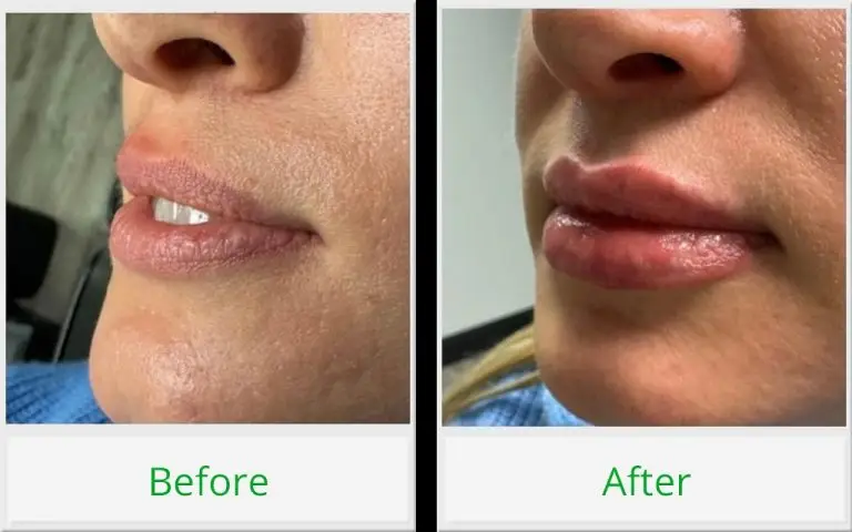 lip filler before and after